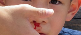 Frequent nose bleeds