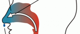 Chronic nasal drip
