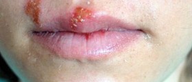 How do I avoid spreading oral herpes to my newborn?