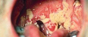 Thrush symptoms in babies