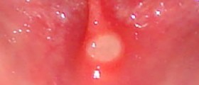 Sores on roof of mouth