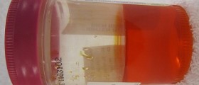 Orange Urine: Benign Medication Side Effect, Or Sign Of Serious Disease?