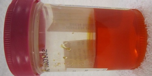 Orange Urine: Benign Medication Side Effect, Or Sign Of Serious Disease?