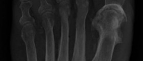 All about osteomyelitis