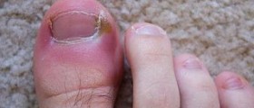 Facts on toe infection