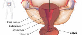 Chronic pelvic inflammatory disease