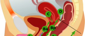 Painful prolapse info