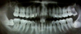 Chronic periodontal disease