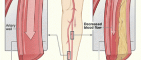 Blocked arteries in legs