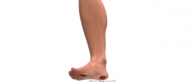 Diabetic foot pain symptoms