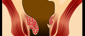Bleeding hemorrhoid treatment