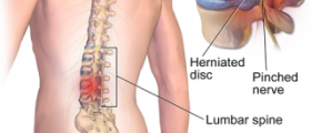 Pinched nerve in lower back