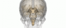 Pineal gland cyst