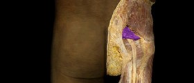 Chronic piriformis syndrome