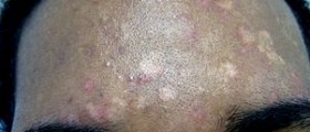 Prevention of tinea versicolor