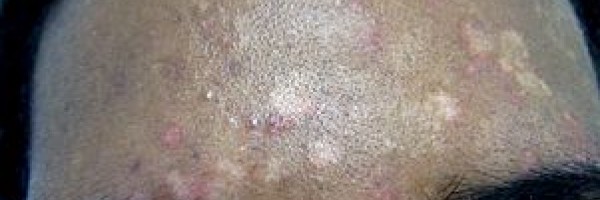 Prevention of tinea versicolor