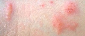 Contact dermatitis symptoms