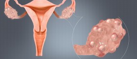 Could you have PCOS?