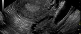Prevention of polycystic ovaries