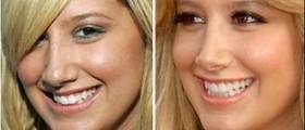 Preparing for a nose job