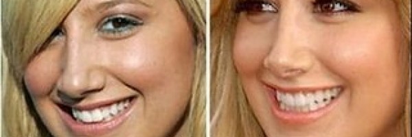 Preparing for a nose job
