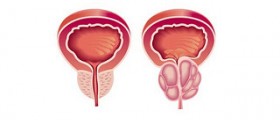 Infertility Raises Risk of More Aggressive Prostate Cancer