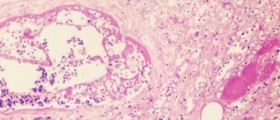 Chronic prostatitis symptoms