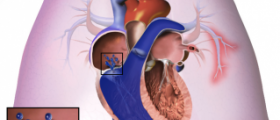 Drug therapy for pulmonary hypertension
