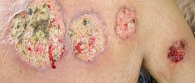 Therapy for pyoderma gangrenosum