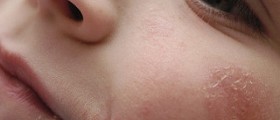 Eczema around eyes