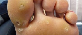 Plantar wart removal: how to get rid of plantar warts