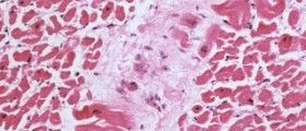 Chronic myocarditis facts