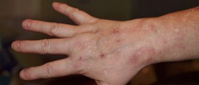Rash on hands