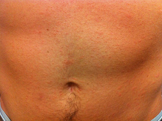 pictures of swimmers itch rash