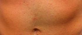 Prevention of ringworm