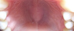 Pain in roof of mouth