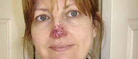Red face treatment