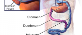 Gastric bypass surgery cost