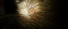 Scalp acne causes