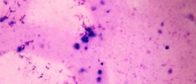 Obstructive Azoospermia Causes