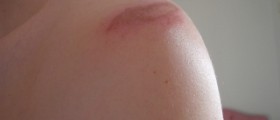 Top of shoulder pain