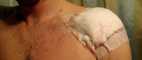Shoulder surgery recovery time