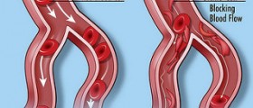 Therapy for sickle cell anemia
