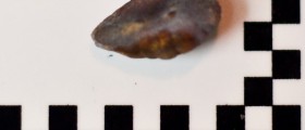 Signs of kidney stones: naturally treat kidney stones by prevention