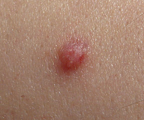 Tiny Red Spots On Skin Bumps Itchy Non Itchy Causes My XXX Hot Girl