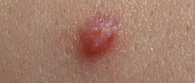 Red itchy bumps