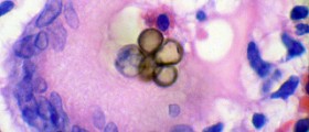 Skin fungus and infections: symptoms and treatment