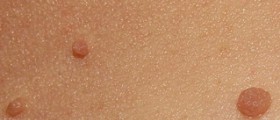 Skin tags on groin
