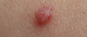 Genital warts and pregnancy complications