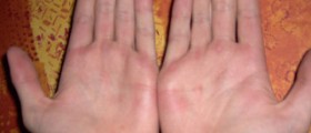 Sore hands